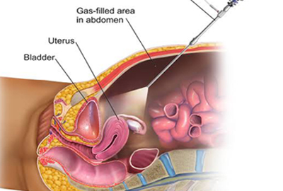 Laparoscopic Surgery